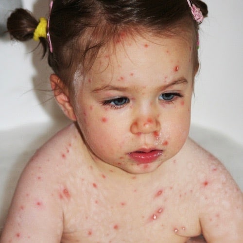 cuida a tu hijo de la varicela