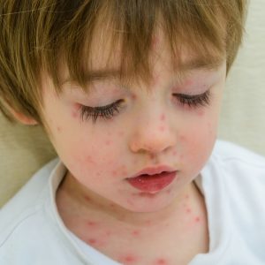 niño con varicela