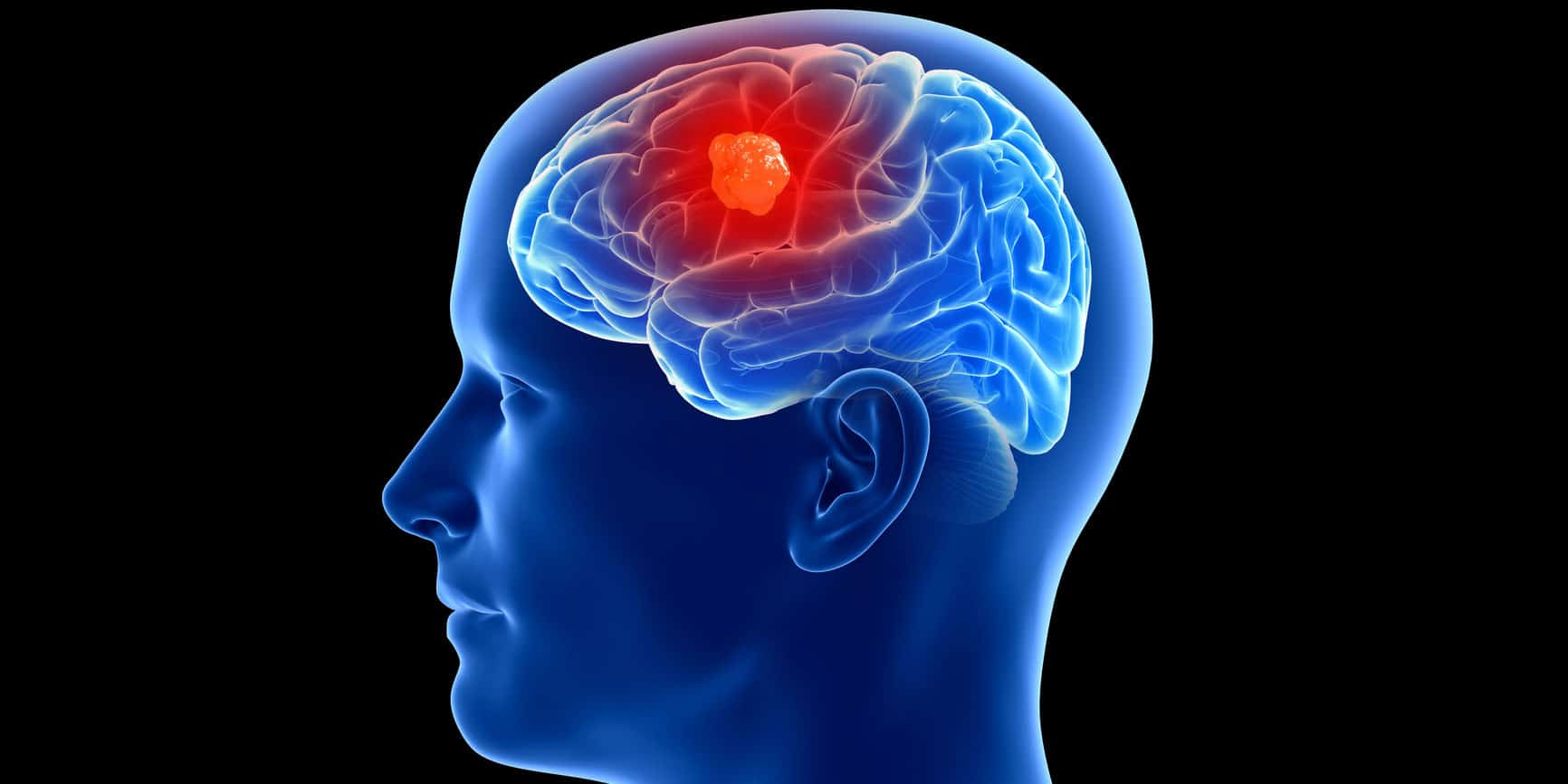 Síntomas frecuentes de un tumor cerebral