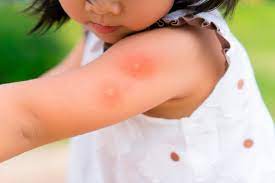 niña con picadura de mosquito