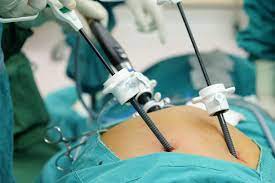 cirugía laparoscopica de vesícula